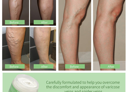 Vein Cream Red Blood Streaks Repair Earthworm Leg Bruises Bulge Relief Pain Safflower Skin care lotion Varicose Cream