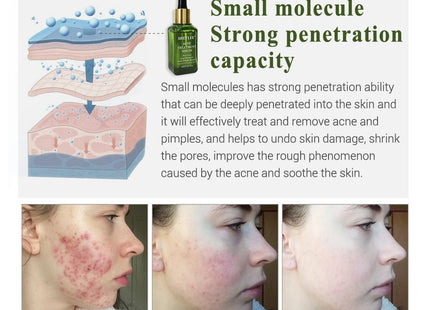 BREYLEE Acne Treatment Serum Face Facial Anti Acne Scar Removal Cream Skin Care Whitening Repair Pimple Remover For Acne