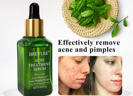 BREYLEE Acne Treatment Serum Face Facial Anti Acne Scar Removal Cream Skin Care Whitening Repair Pimple Remover For Acne