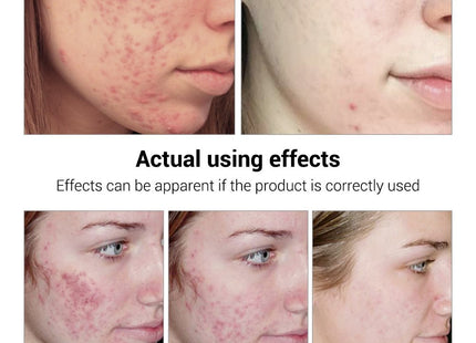BREYLEE Acne Treatment Serum Face Facial Anti Acne Scar Removal Cream Skin Care Whitening Repair Pimple Remover For Acne