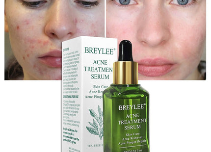 BREYLEE Acne Treatment Serum Face Facial Anti Acne Scar Removal Cream Skin Care Whitening Repair Pimple Remover For Acne