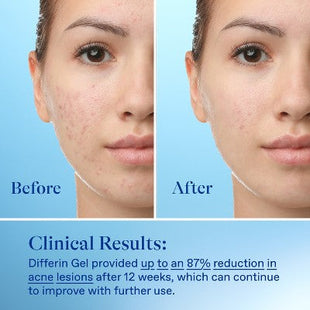 Differin Acne Retinoid Face and Body Treatment Gel Adapalene 0.1% 45g - Imperfect Box