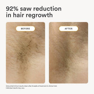 Nood The Flasher 2.0 IPL Permanent Hair Removal - Imperfect Box